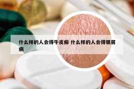什么樣的人會(huì)得牛皮癬 什么樣的人會(huì)得銀屑病