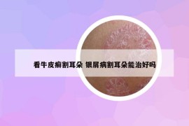看牛皮癬割耳朵 銀屑病割耳朵能治好嗎