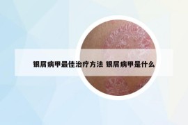 銀屑病甲最佳治療方法 銀屑病甲是什么