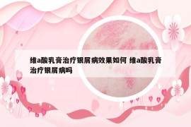 維a酸乳膏治療銀屑病效果如何 維a酸乳膏治療銀屑病嗎