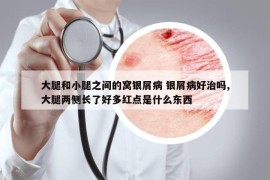 大腿和小腿之間的窩銀屑病 銀屑病好治嗎,大腿兩側(cè)長了好多紅點是什么東西