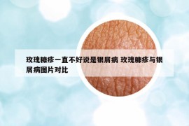 玫瑰糠疹一直不好說是銀屑病 玫瑰糠疹與銀屑病圖片對比