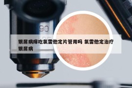 銀屑病癢吃氯雷他定片管用嗎 氯雷他定治療銀屑病