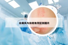 白癜風與白班有何區(qū)別圖片