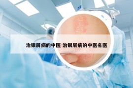 治銀屑病的中醫(yī) 治銀屑病的中醫(yī)名醫(yī)
