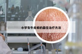 小學(xué)生牛皮癬的最佳治療方法