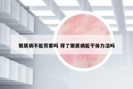 銀屑病不能勞累嗎 得了銀屑病能干體力活嗎