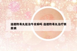 連翹敗毒丸能治牛皮癬嗎 連翹敗毒丸治療銀屑病