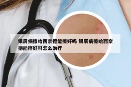 銀屑病擦哈西奈德能擦好嗎 銀屑病擦哈西奈德能擦好嗎怎么治療