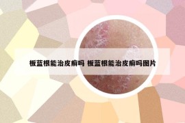 板藍根能治皮癬嗎 板藍根能治皮癬嗎圖片