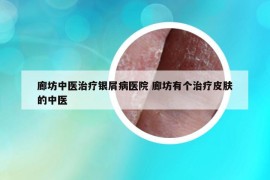 廊坊中醫(yī)治療銀屑病醫(yī)院 廊坊有個(gè)治療皮膚的中醫(yī)