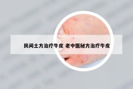 民間土方治療牛皮 老中醫(yī)秘方治療牛皮