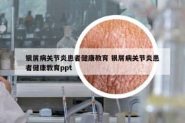 銀屑病關(guān)節(jié)炎患者健康教育 銀屑病關(guān)節(jié)炎患者健康教育ppt