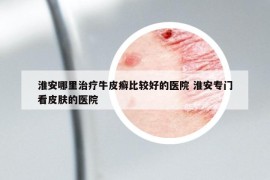 淮安哪里治療牛皮癬比較好的醫(yī)院 淮安專門看皮膚的醫(yī)院