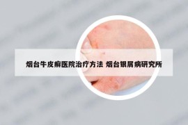 煙臺牛皮癬醫(yī)院治療方法 煙臺銀屑病研究所