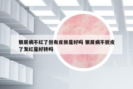 銀屑病不紅了但有皮損是好嗎 銀屑病不脫皮了發(fā)紅是好轉(zhuǎn)嗎