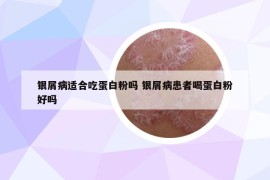 銀屑病適合吃蛋白粉嗎 銀屑病患者喝蛋白粉好嗎