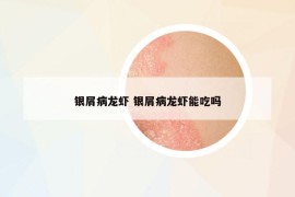 銀屑病龍蝦 銀屑病龍蝦能吃嗎