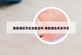 銀屑病關(guān)節(jié)炎會融合嗎 銀屑病合并關(guān)節(jié)炎