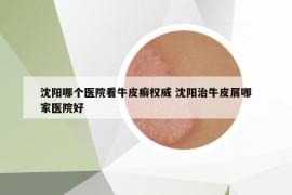 沈陽哪個醫(yī)院看牛皮癬權(quán)威 沈陽治牛皮屑哪家醫(yī)院好