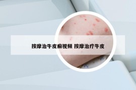 按摩治牛皮癬視頻 按摩治療牛皮