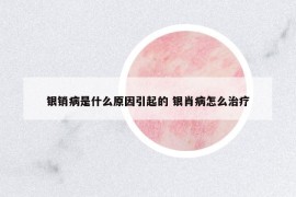 銀銷病是什么原因引起的 銀肖病怎么治療