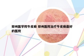 鄭州醫(yī)學院牛皮癬 鄭州醫(yī)院治療牛皮癬最好的醫(yī)院