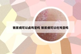 銀屑病可以鹵雞蛋嗎 銀屑病可以吃雞蛋嗎
