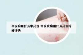 牛皮癬用什么中藥洗 牛皮皮癬用什么藥治療好得快