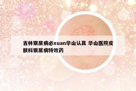 吉林銀屑病必xuan華山認真 華山醫(yī)院皮膚科銀屑病特效藥