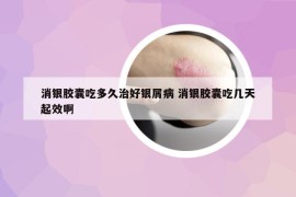 消銀膠囊吃多久治好銀屑病 消銀膠囊吃幾天起效啊