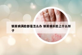銀屑病滿臉都是怎么辦 銀屑病長臉上什么樣子