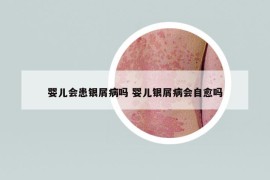 嬰兒會(huì)患銀屑病嗎 嬰兒銀屑病會(huì)自愈嗎