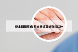 穩(wěn)定期銀屑病 穩(wěn)定期銀屑病突然紅腫