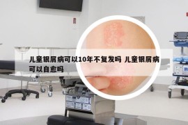 兒童銀屑病可以10年不復(fù)發(fā)嗎 兒童銀屑病可以自愈嗎