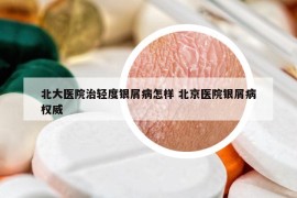 北大醫(yī)院治輕度銀屑病怎樣 北京醫(yī)院銀屑病權(quán)威