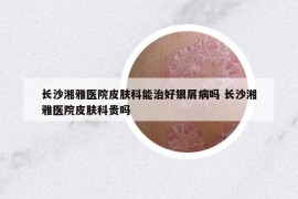 長(zhǎng)沙湘雅醫(yī)院皮膚科能治好銀屑病嗎 長(zhǎng)沙湘雅醫(yī)院皮膚科貴嗎