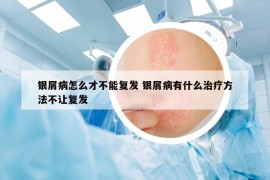 銀屑病怎么才不能復(fù)發(fā) 銀屑病有什么治療方法不讓復(fù)發(fā)