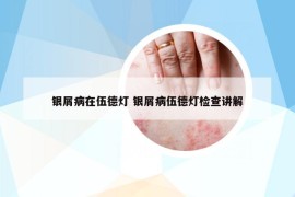 銀屑病在伍德燈 銀屑病伍德燈檢查講解
