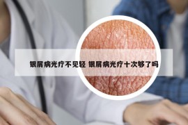 銀屑病光療不見輕 銀屑病光療十次夠了嗎