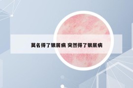 莫名得了銀屑病 突然得了銀屑病