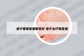 南寧看銀屑病那家好 南寧治療銀屑病