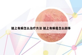 腿上有癬怎么治療方法 腿上有癬是怎么回事