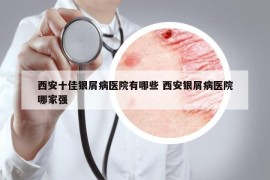 西安十佳銀屑病醫(yī)院有哪些 西安銀屑病醫(yī)院哪家強(qiáng)