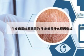 牛皮癬是啥原因得的 牛皮癬是什么原因造成