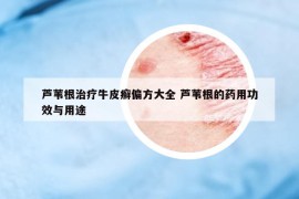 蘆葦根治療牛皮癬偏方大全 蘆葦根的藥用功效與用途