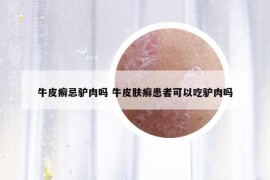 牛皮癬忌驢肉嗎 牛皮膚癬患者可以吃驢肉嗎