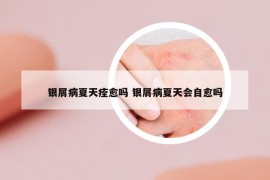 銀屑病夏天痊愈嗎 銀屑病夏天會(huì)自愈嗎