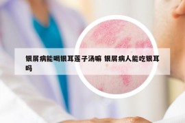 銀屑病能喝銀耳蓮子湯嘛 銀屑病人能吃銀耳嗎