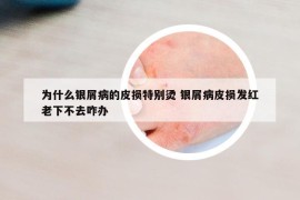 為什么銀屑病的皮損特別燙 銀屑病皮損發(fā)紅老下不去咋辦